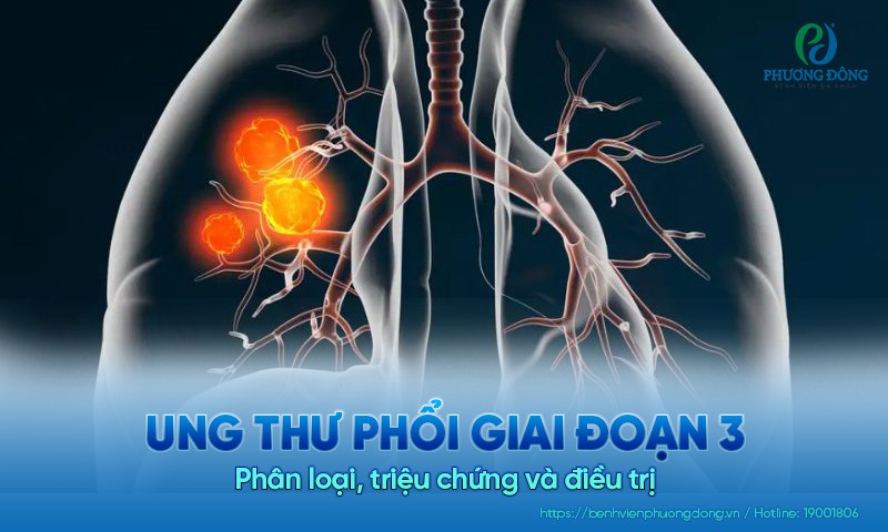 Ung thư phổi giai đoạn 3: Phân loại, triệu chứng và điều trị