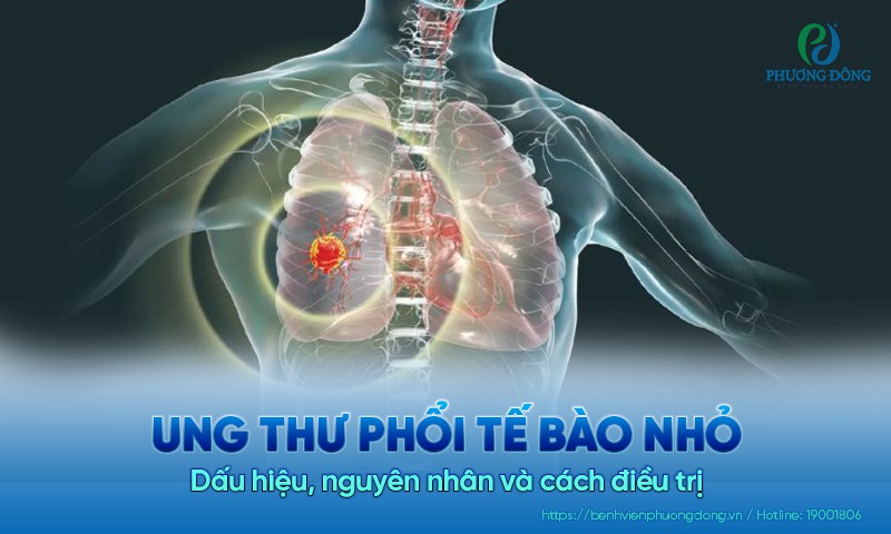 Ung thư phổi tế bào nhỏ: Triệu chứng, nguyên nhân và điều trị