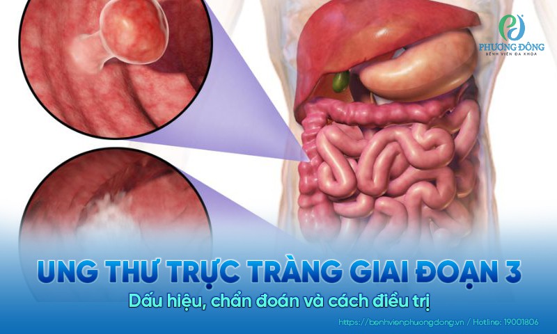 Ung thư trực tràng giai đoạn 3: Dấu hiệu, chẩn đoán và cách điều trị