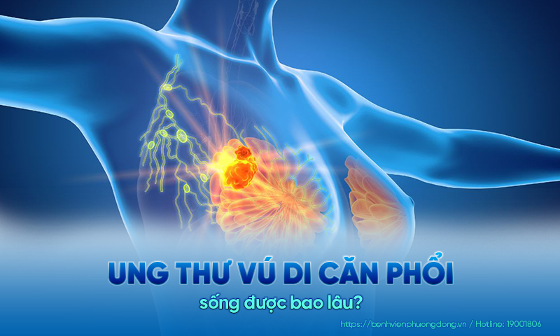 Giải đáp chi tiết: Ung thư vú di căn phổi sống được bao lâu?