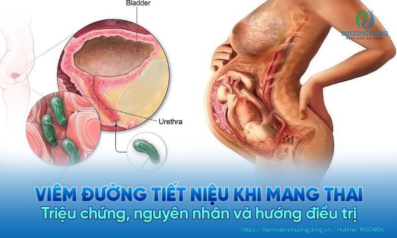 Viêm đường tiết niệu khi mang thai: Triệu chứng và nguyên nhân