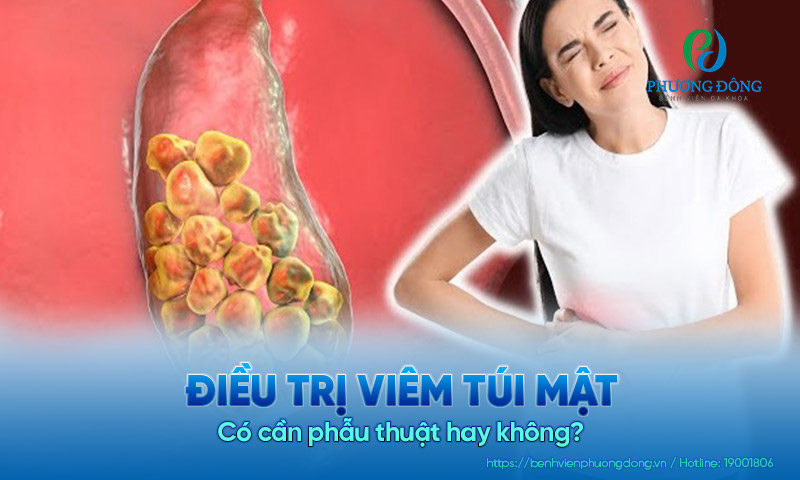 Điều trị viêm túi mật: Có cần phẫu thuật hay không?