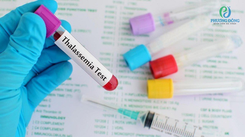 Xét nghiệm Thalassemia có cần nhịn ăn không? Các xét nghiệm liên quan