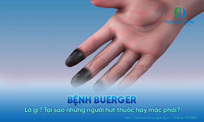 Bệnh Buerger là gì? Tại sao những người hút thuốc hay mắc phải?