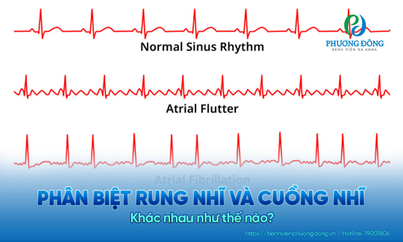 Phân biệt rung nhĩ và cuồng nhĩ: Khác nhau điểm nào?