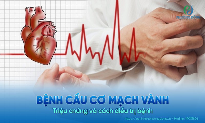 Bệnh cầu cơ mạch vành: Triệu chứng và cách điều trị bệnh