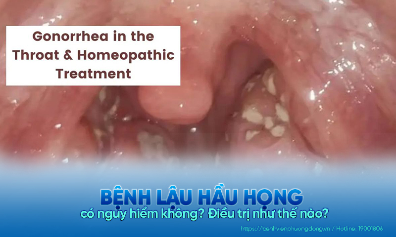 Bệnh lậu hầu họng có nguy hiểm không? Điều trị như thế nào?