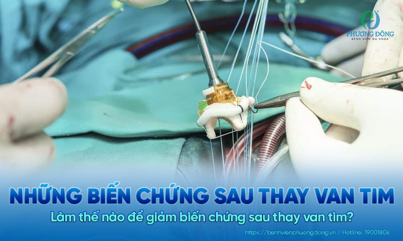 Những biến chứng sau thay van tim có thể gặp phải