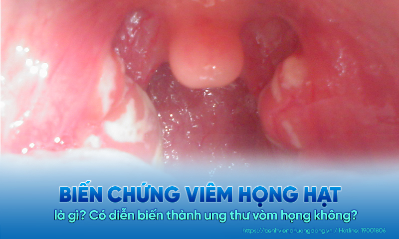 Biến chứng viêm họng hạt là gì? Có diễn biến thành ung thư vòm họng không?