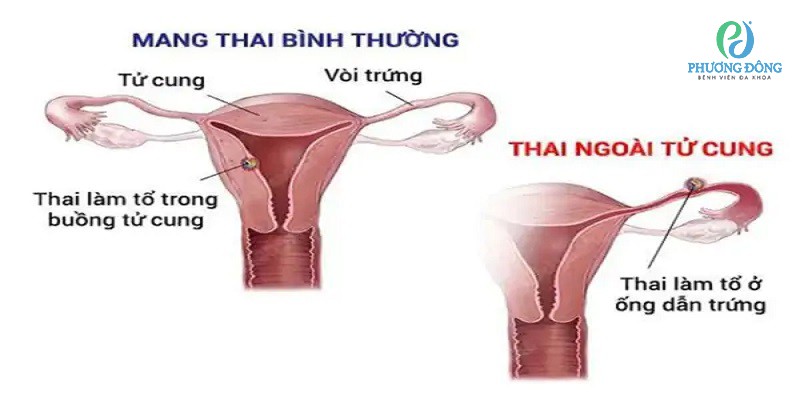 Nếu tình trạng đau bụng kéo dài không thuyên giảm đây có thể là dấu hiệu vết mổ đã bị nhiễm trùng