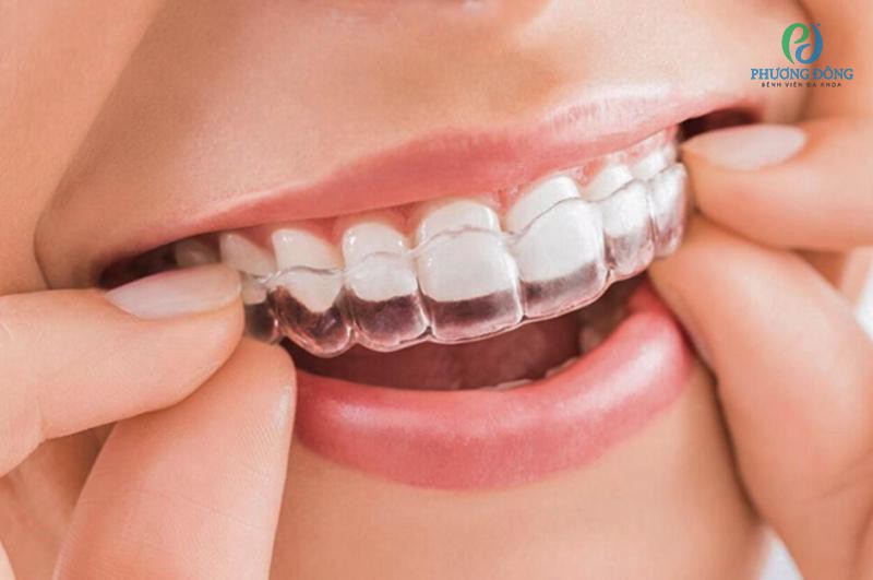 Không nhất thiết phải nhổ răng mới đem lại hiệu quả khi niềng