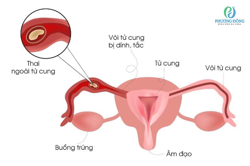 Thai ngoài tử cung có thể có tim thai nhưng rất nguy hiểm với phụ nữ