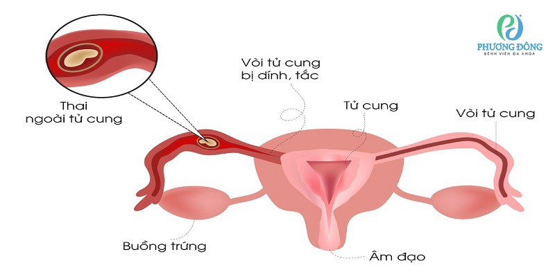 Thai ngoài tử cung thể huyết tụ thành nang