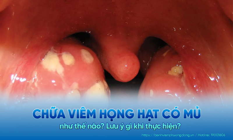 Chữa viêm họng hạt có mủ như thế nào? Lưu ý gì khi thực hiện?
