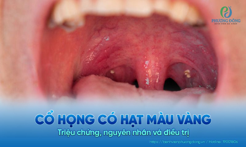 Cổ họng có hạt màu vàng: Triệu chứng, nguyên nhân và điều trị