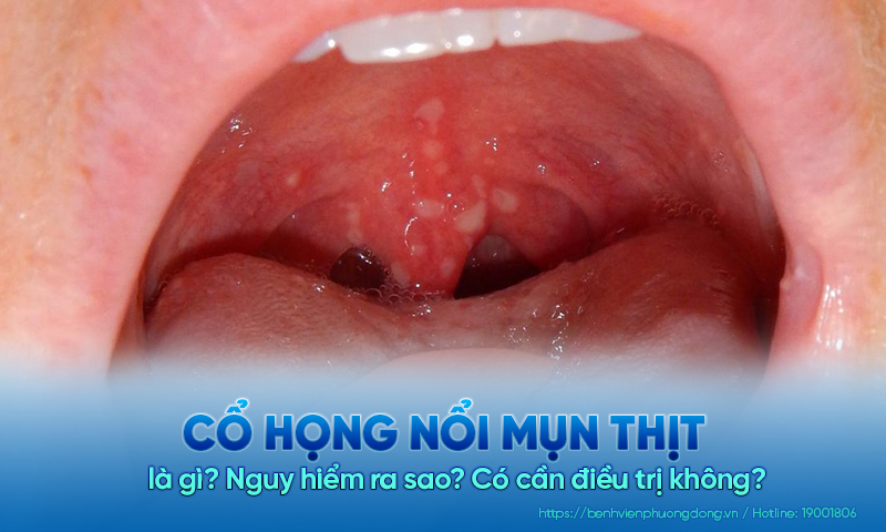 Cổ họng nổi mụn thịt có sao không? Nên điều trị như thế nào?