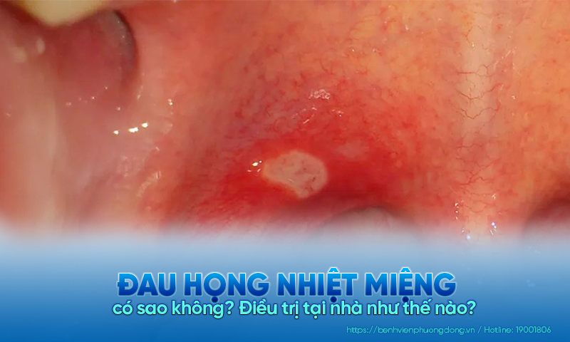 Đau họng nhiệt miệng có sao không? Điều trị tại nhà như thế nào?