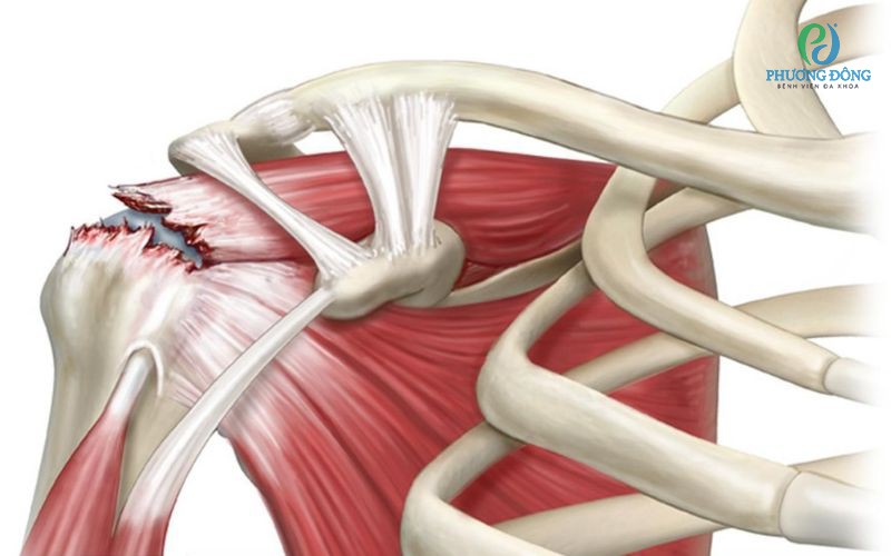 Đứt gân trên gai - 1 bệnh lý hay gặp nhưng thường bị bỏ qua