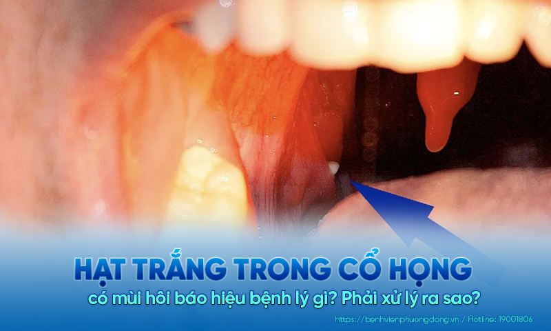 Hạt trắng trong cổ họng có mùi hôi báo hiệu bệnh lý gì? Phải xử lý ra sao?