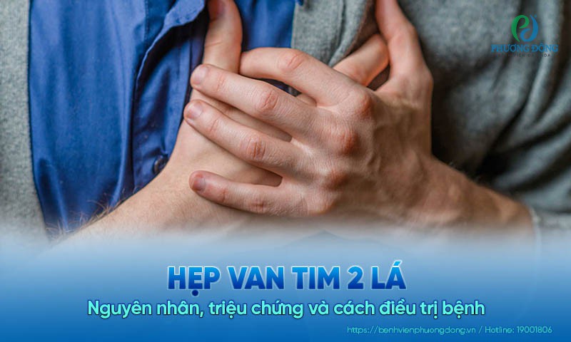 Hẹp van tim 2 lá: Nguyên nhân, triệu chứng và cách điều trị bệnh