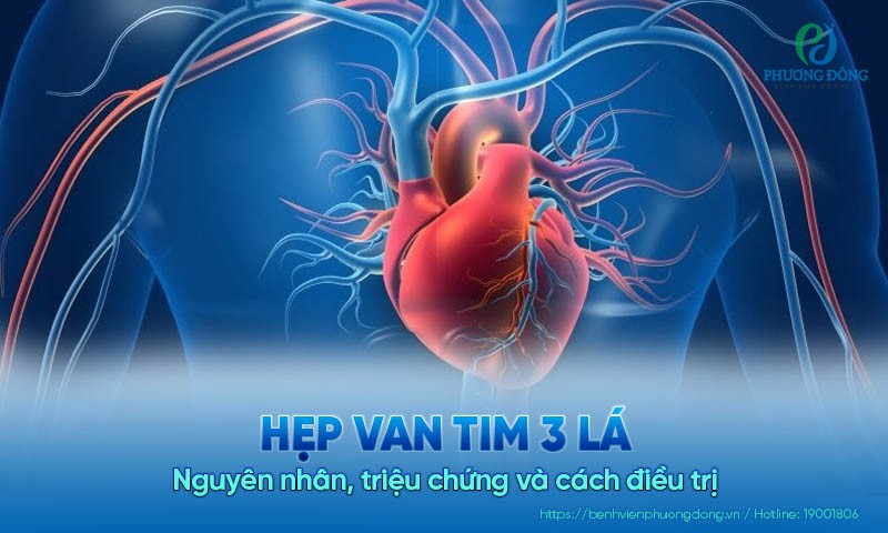 Hẹp van tim 3 lá: Nguyên nhân, triệu chứng và cách điều trị