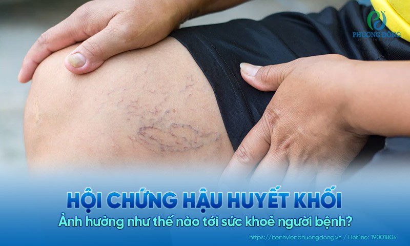 Hội chứng hậu huyết khối: Ảnh hưởng như thế nào tới sức khoẻ?