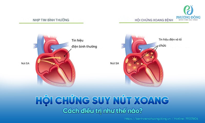 Hội chứng suy nút xoang và cách điều trị hiệu quả