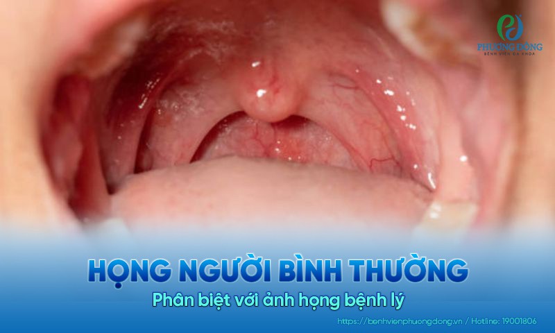 Phân biệt họng người bình thường với ảnh họng bệnh lý