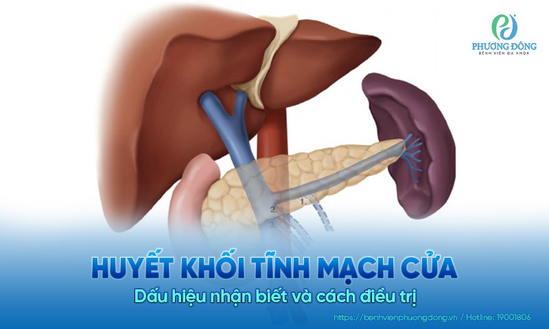 Huyết khối tĩnh mạch cửa: Dấu hiệu nhận biết và cách điều trị