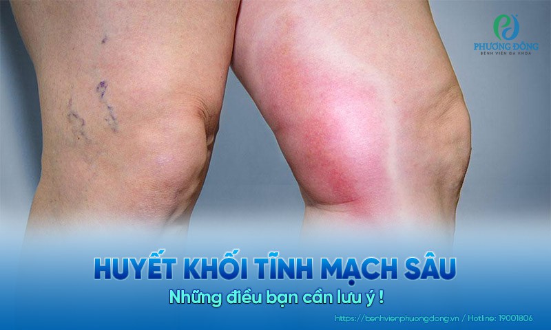 Huyết khối tĩnh mạch sâu: Những điều bạn cần lưu ý