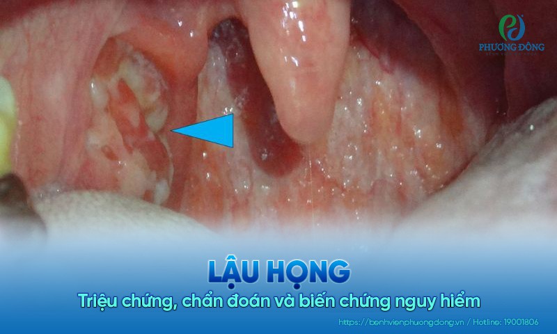 Lậu họng: Triệu chứng, chẩn đoán và biến chứng nguy hiểm
