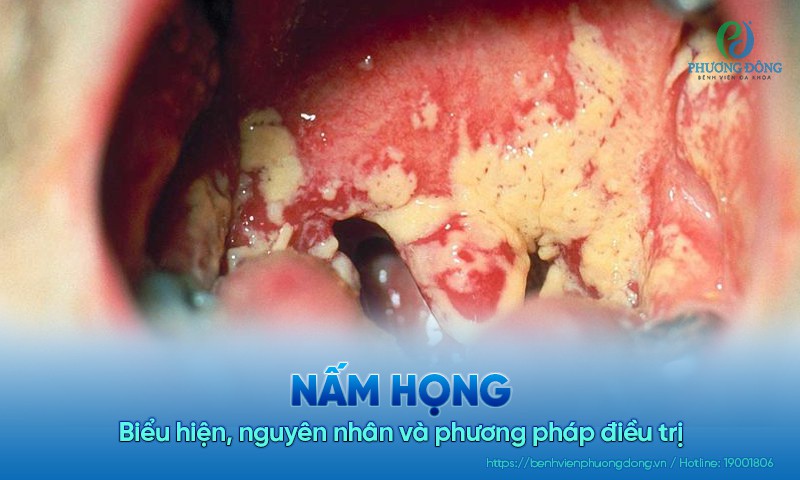 Nấm họng: Biểu hiện, nguyên nhân và phương pháp điều trị