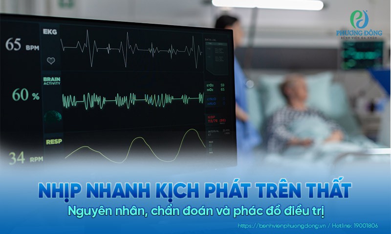 Nhịp nhanh kịch phát trên thất: Nguyên nhân, chẩn đoán và phác đồ điều trị