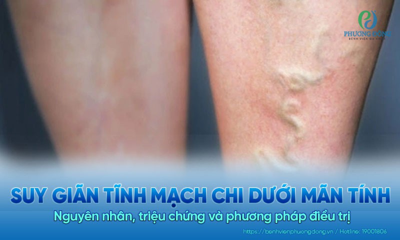 Suy giãn tĩnh mạch chi dưới mãn tính: Nguyên nhân, triệu chứng và cách điều trị