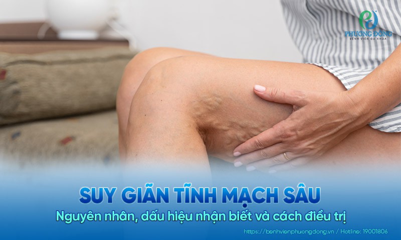 Suy giãn tĩnh mạch sâu: Nguyên nhân, dấu hiệu nhận biết, cách điều trị 