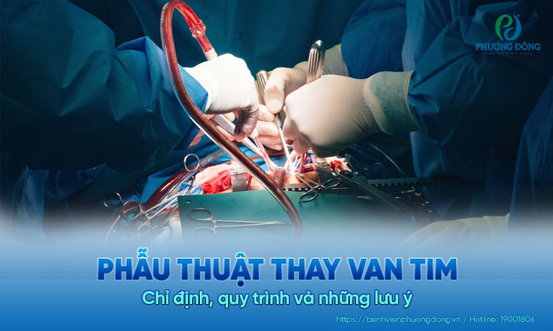 Phẫu thuật thay van tim: Chỉ định, quy trình và những lưu ý