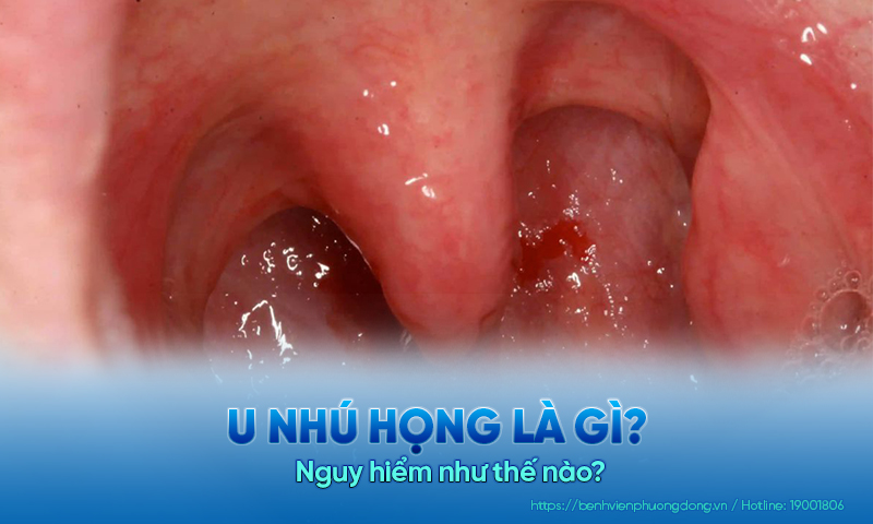 U nhú họng là gì? Nguy hiểm như thế nào?