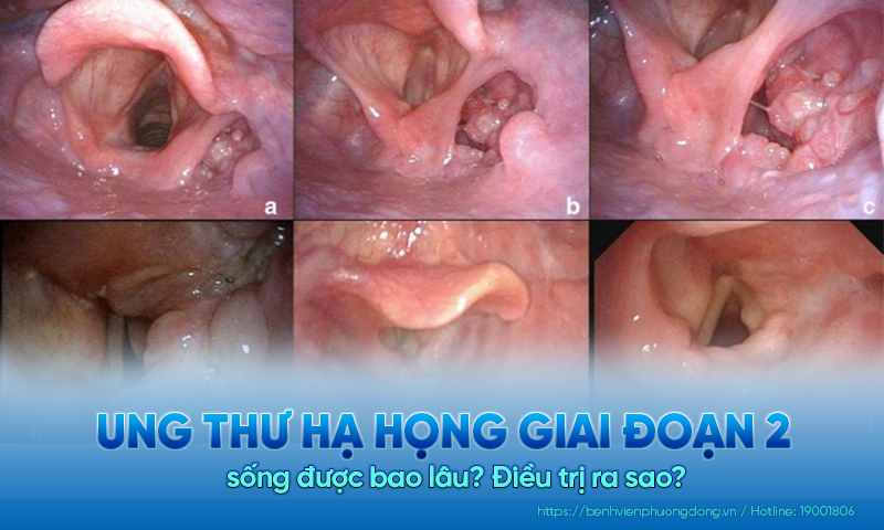 Ung thư hạ họng giai đoạn 2 sống được bao lâu? Điều trị ra sao?