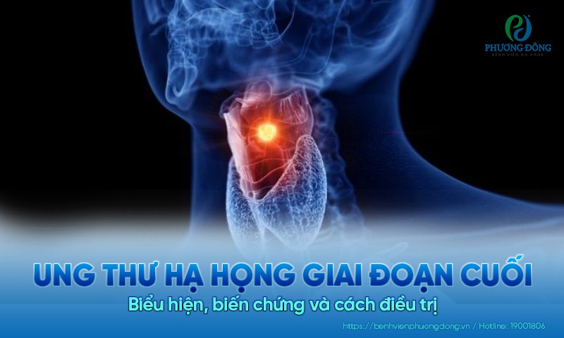 Ung thư hạ họng giai đoạn cuối: Biểu hiện, biến chứng và cách điều trị