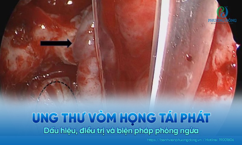 Ung thư vòm họng tái phát: Dấu hiệu, điều trị và biện pháp phòng ngừa