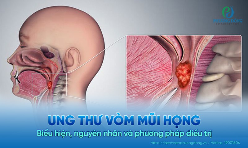 Ung thư vòm mũi họng: Biểu hiện, nguyên nhân và phương pháp điều trị