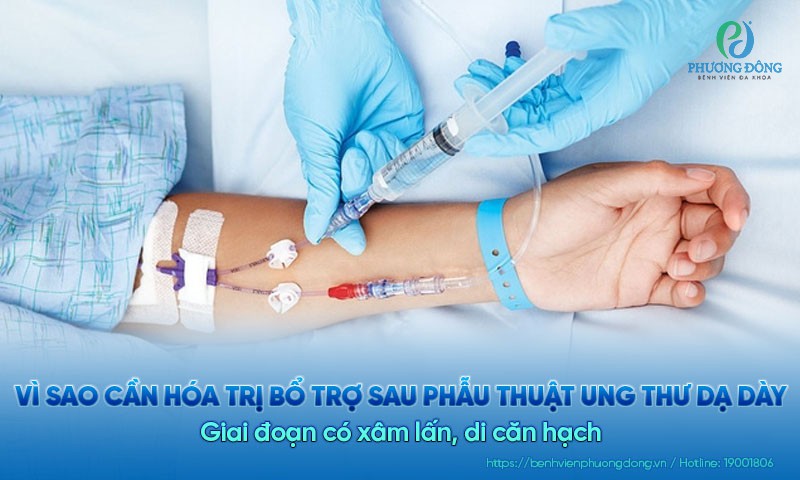 Vì sao cần hóa trị bổ trợ sau phẫu thuật ung thư dạ dày giai đoạn có xâm lấn, di căn hạch