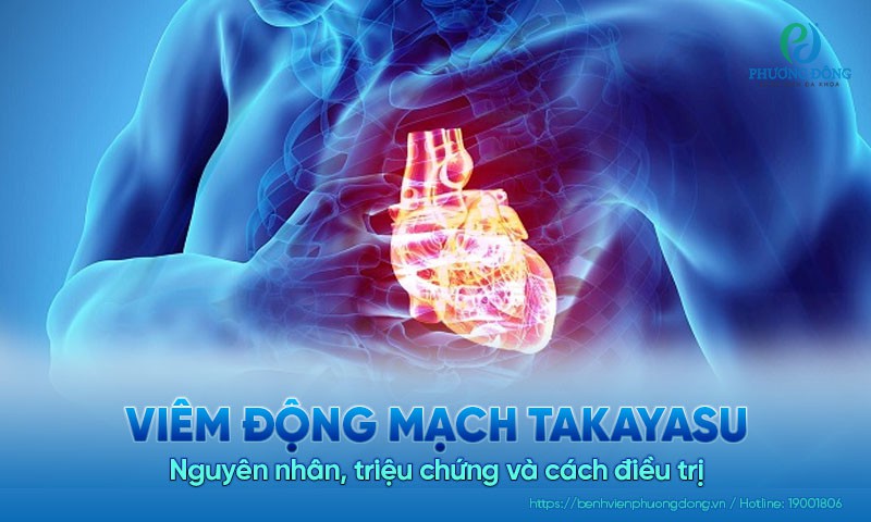 Viêm động mạch takayasu: Nguyên nhân, triệu chứng và cách điều trị