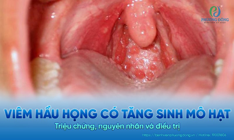 Viêm hầu họng có tăng sinh mô hạt: Triệu chứng, nguyên nhân và điều trị