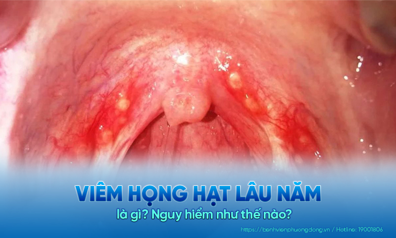 Viêm họng hạt lâu năm có chữa khỏi được không? Điều trị như thế nào?