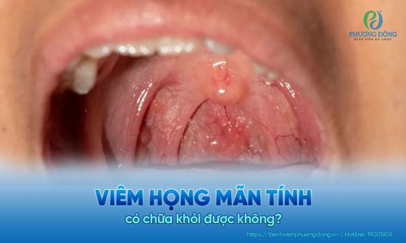 Viêm họng mãn tính có chữa khỏi được không? Phương pháp điều trị
