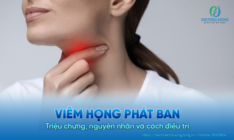 Viêm họng phát ban: Triệu chứng, nguyên nhân và cách điều trị