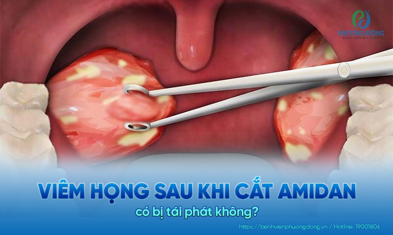 Viêm họng sau khi cắt amidan có bị tái phát không?