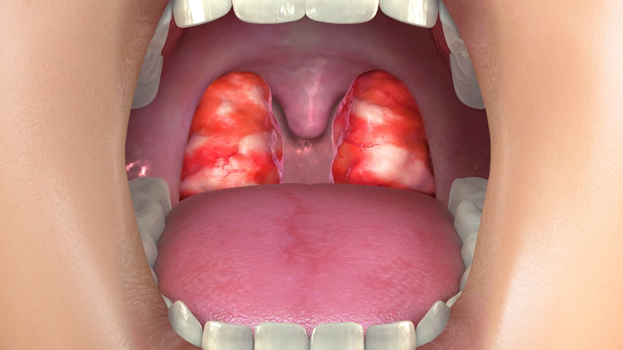 Vi khuẩn khiến họng bị viêm nhiễm liên tục và nhiều lần