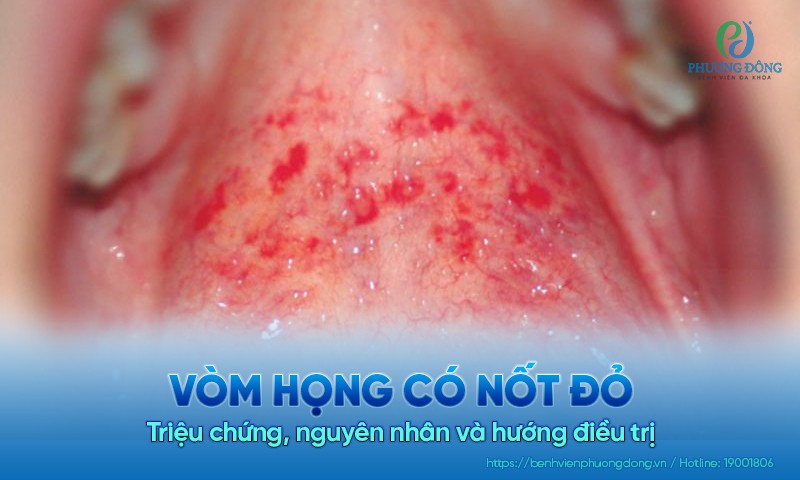 Vòm họng có nốt đỏ: Triệu chứng, nguyên nhân và hướng điều trị